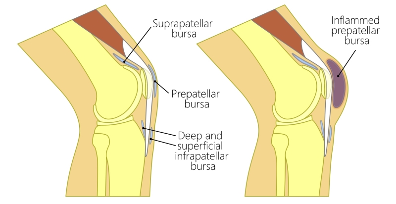 Prepatellar Bursitis 